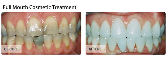 Full Mouth Cosmetic Treatment
