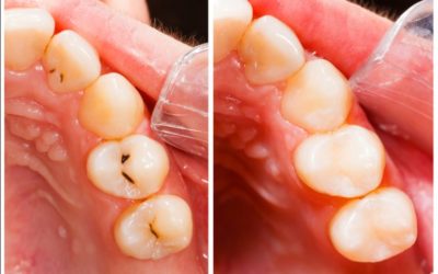 Composite Tooth-Colored Fillings