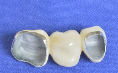 PFM Restorations